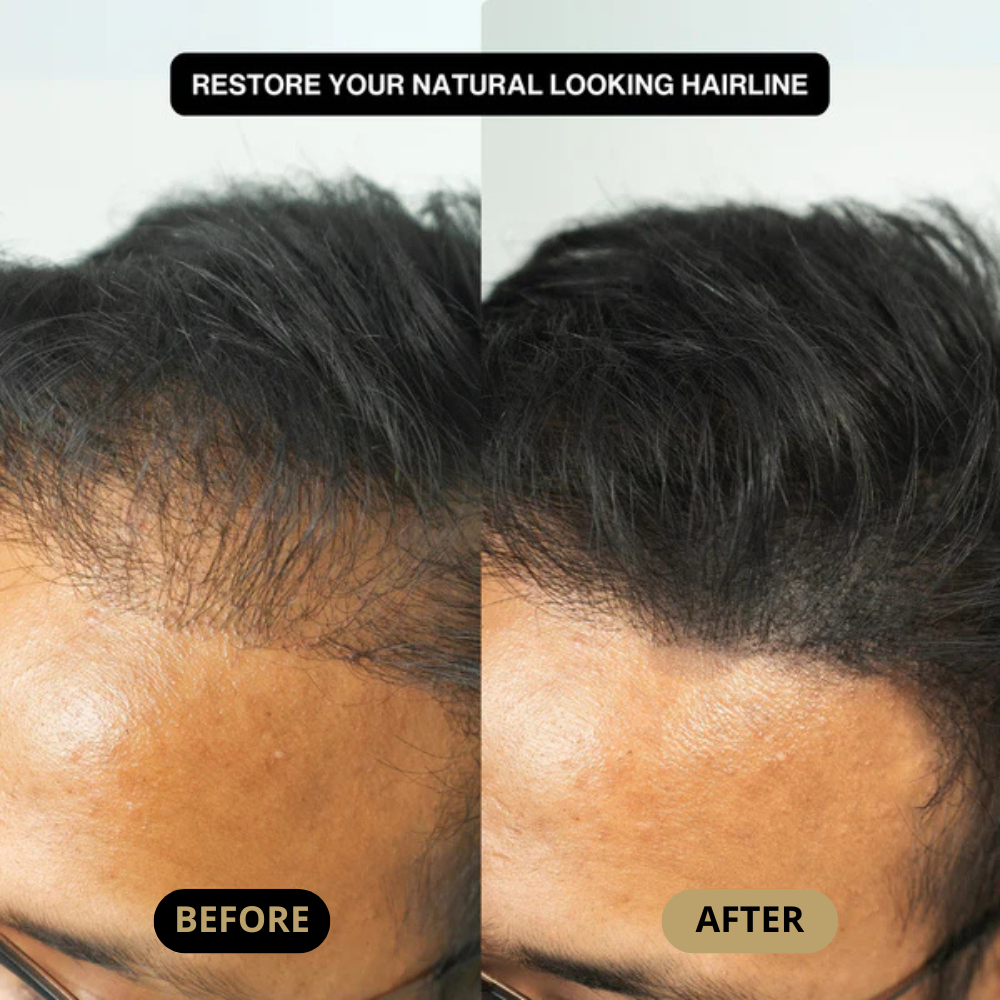 Hair Density Filler